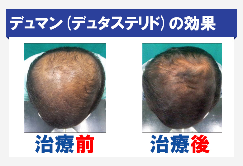 デュマンによる育毛効果