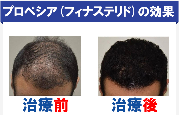 プロペシアによる育毛効果