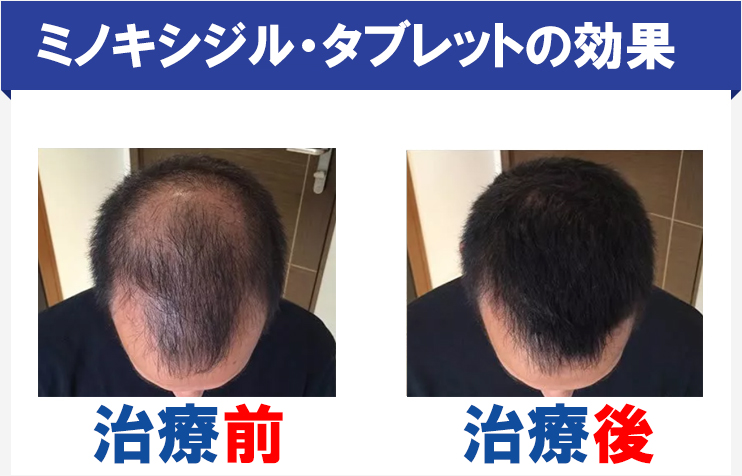 ミノキシジルタブレットによる育毛効果